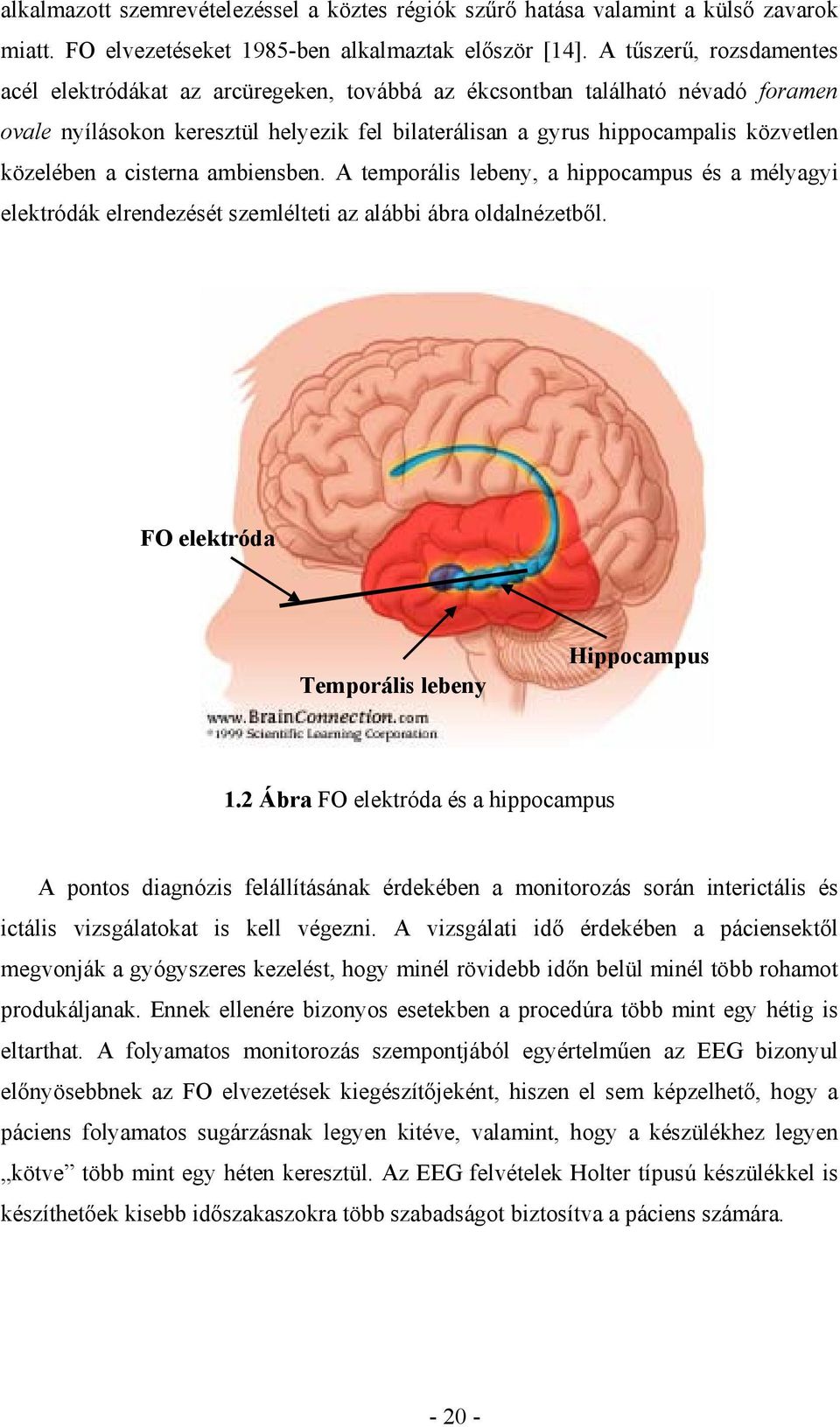 közelében a cisterna ambiensben. A temporális lebeny, a hippocampus és a mélyagyi elektródák elrendezését szemlélteti az alábbi ábra oldalnézetből. FO elektróda Temporális lebeny Hippocampus 1.