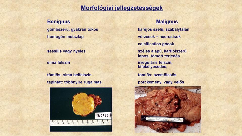 karéjos szélű, szabálytalan vérzések necrosisok calcificatios gócok széles alapú,