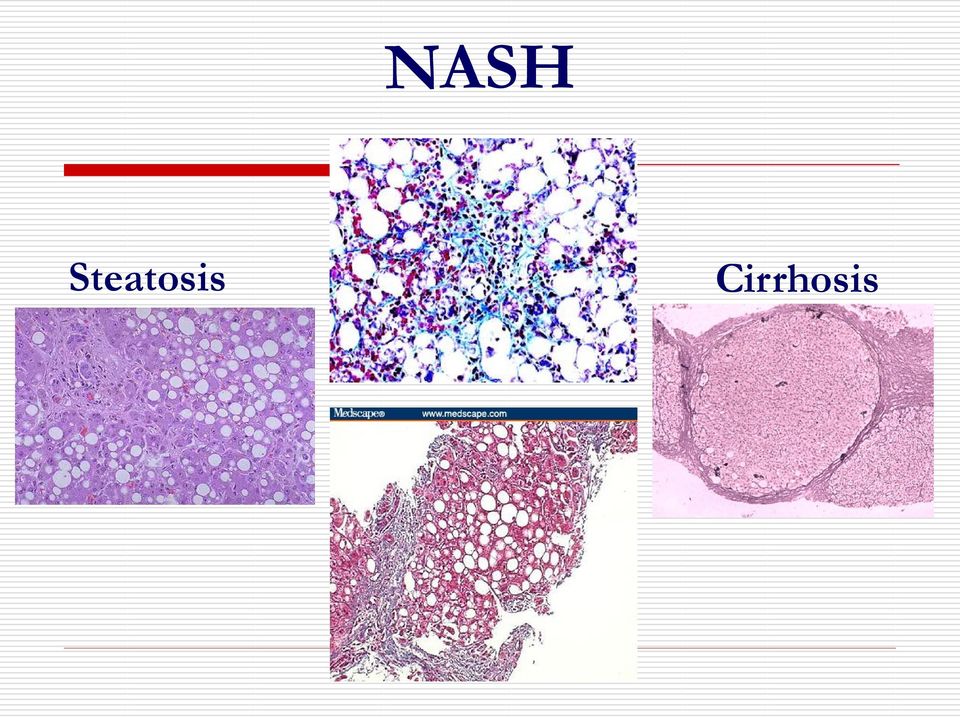 Cirrhosis