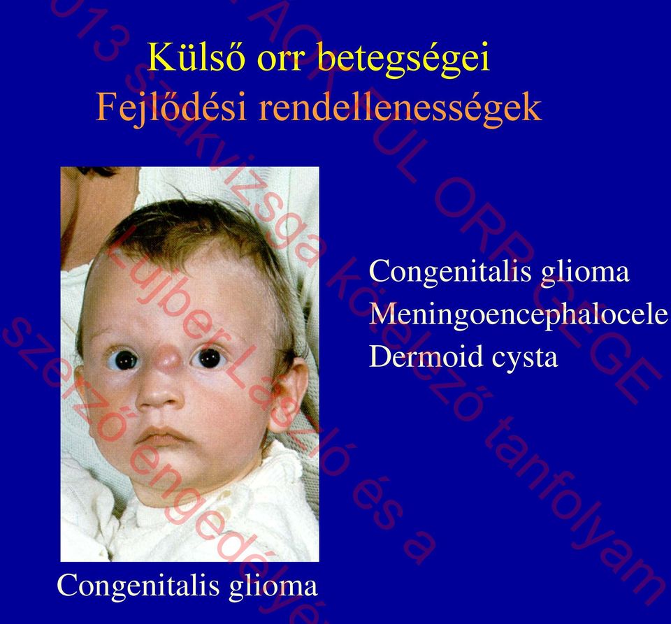 glioma Meningoencephalocele