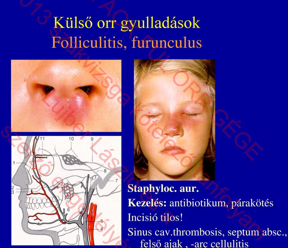 Sinus cav.thrombosis, septum absc.