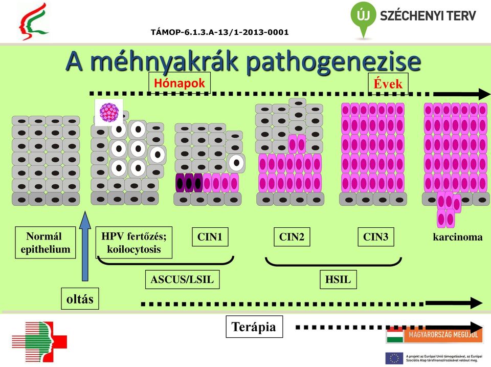 fertőzés; koilocytosis CIN1 CIN2
