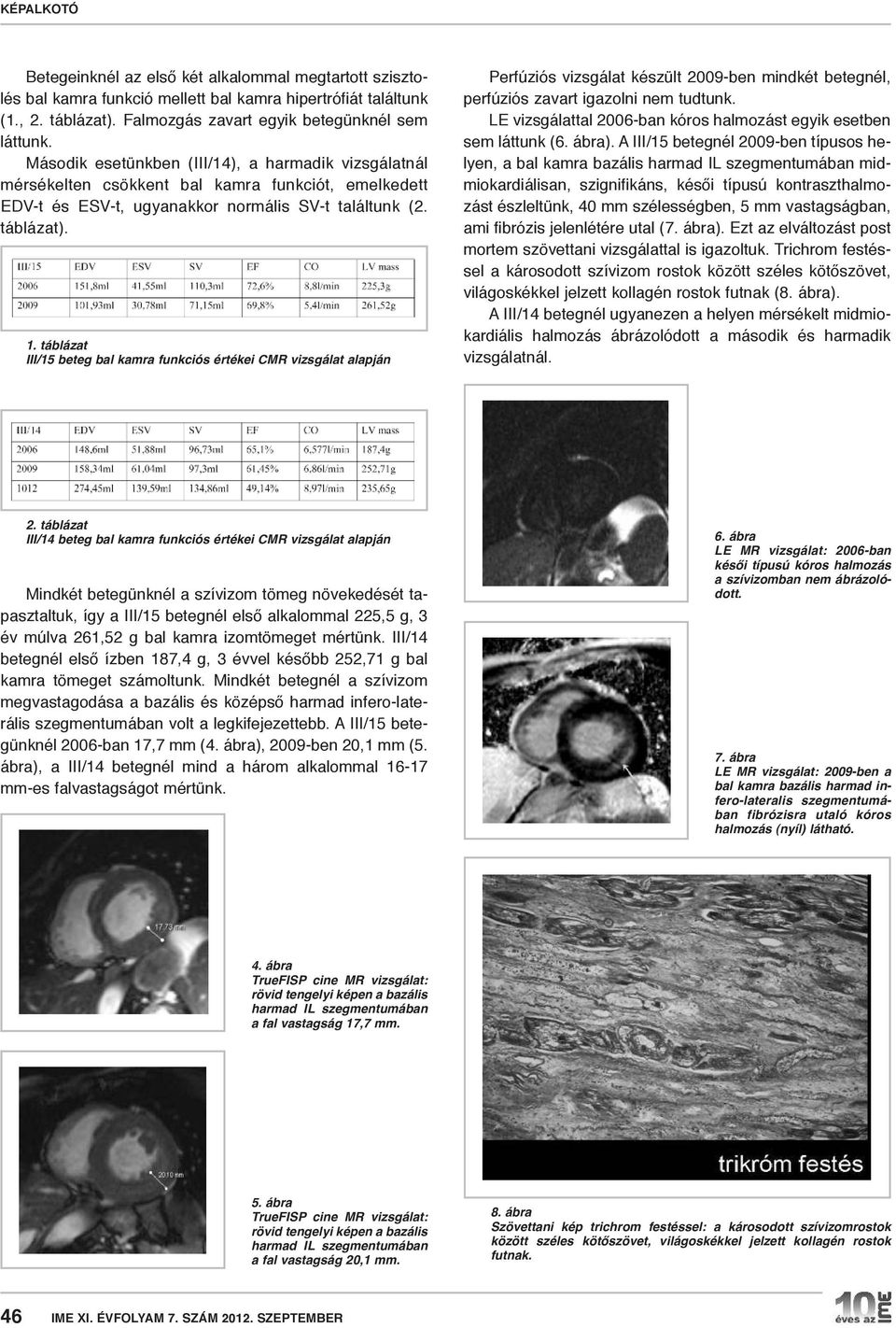 táblázat III/15 beteg bal kamra funkciós értékei CMR vizsgálat alapján Perfúziós vizsgálat készült 2009-ben mindkét betegnél, perfúziós zavart igazolni nem tudtunk.