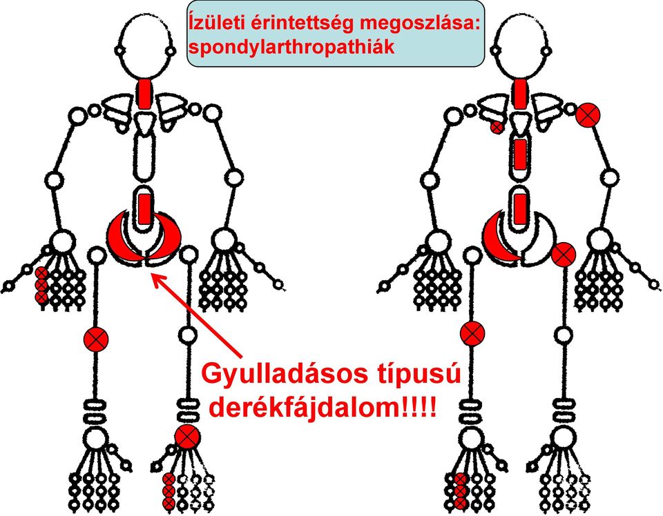 spondylarthropathiák