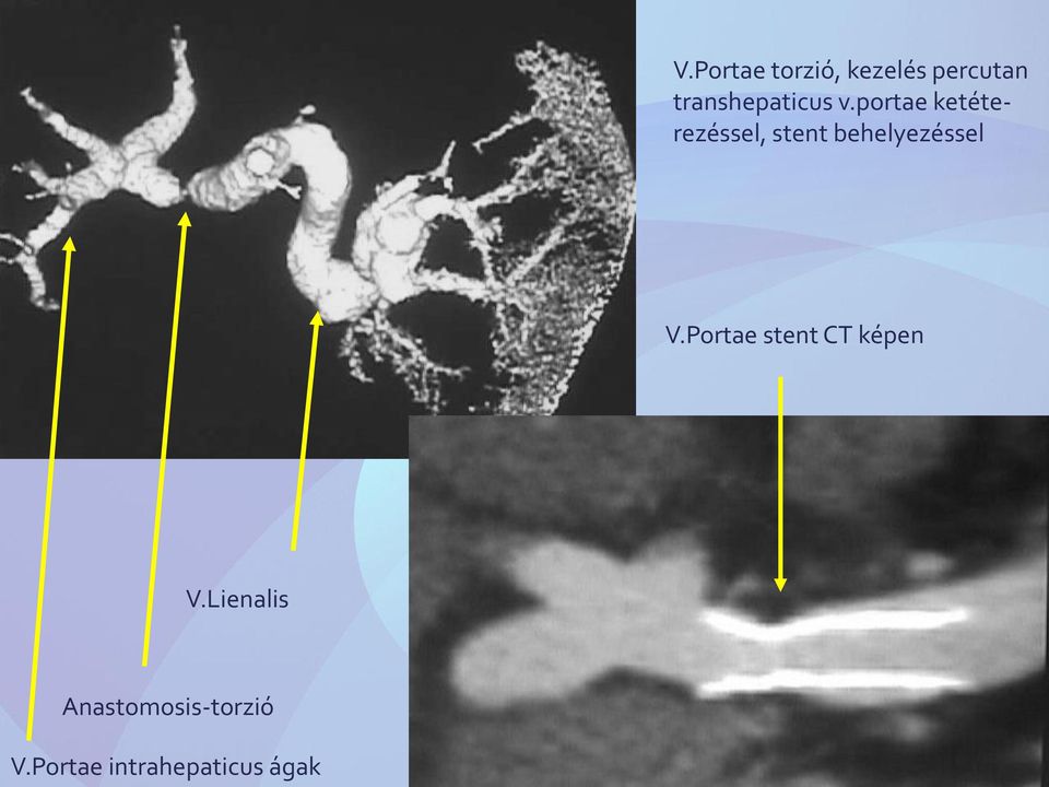 portae ketéterezéssel, stent behelyezéssel