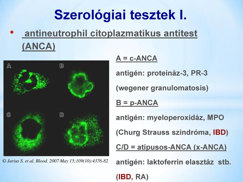 PR-3 (wegener granulomatosis) B = p-anca antigén: myeloperoxidáz, MPO (Churg