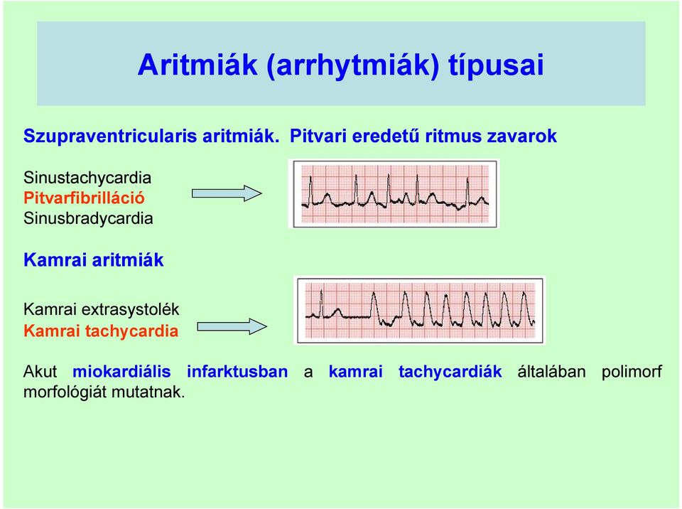 Sinusbradycardia Kamrai aritmiák Kamrai extrasystolék Kamrai tachycardia