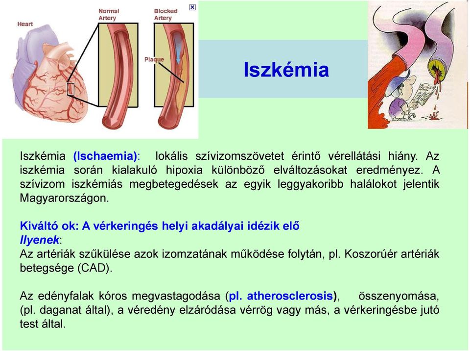 A szívizom iszkémiás megbetegedések az egyik leggyakoribb halálokot jelentik Magyarországon.