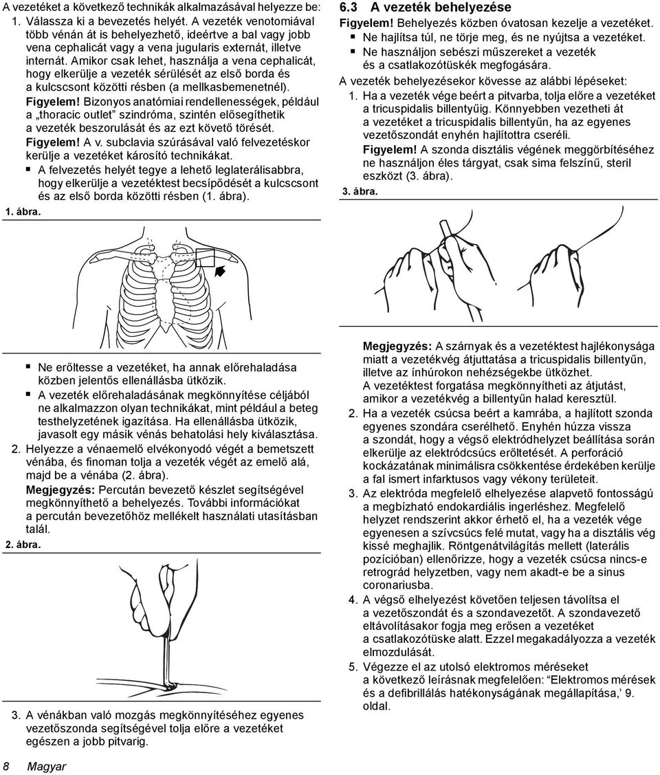 Amikor csak lehet, használja a vena cephalicát, hogy elkerülje a vezeték sérülését az első borda és a kulcscsont közötti résben (a mellkasbemenetnél). Figyelem!