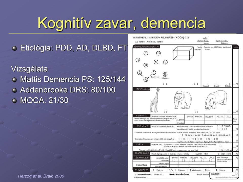 Demencia PS: 125/144 Addenbrooke DRS: