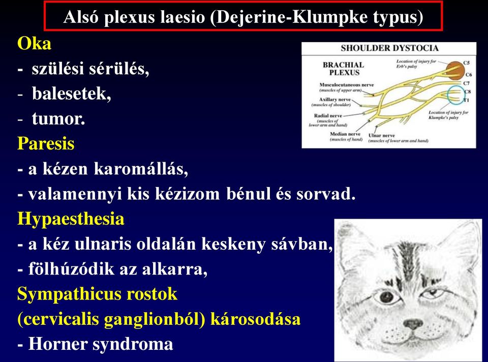 Paresis - a kézen karomállás, - valamennyi kis kézizom bénul és sorvad.