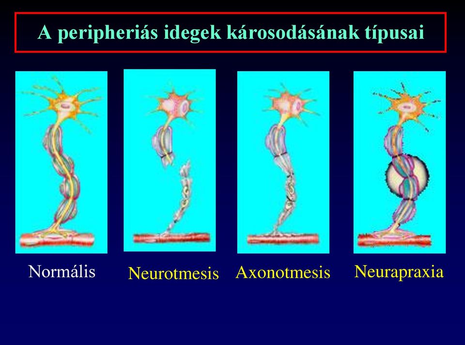 Normális Neurotmesis