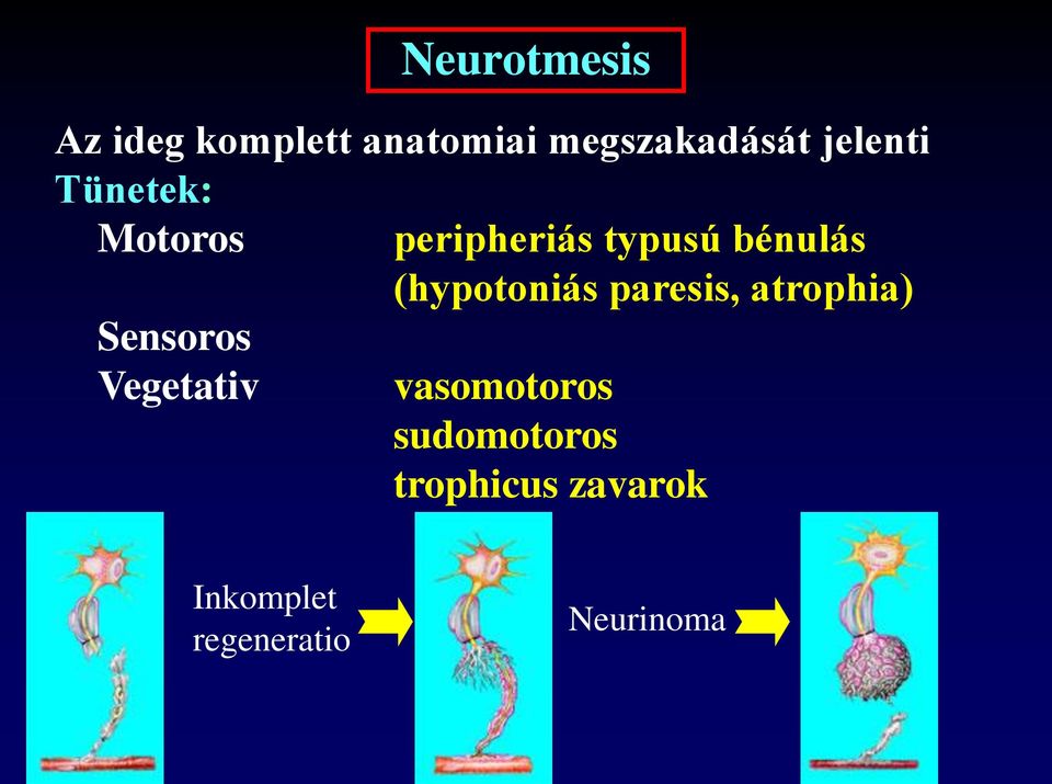 typusú bénulás (hypotoniás paresis, atrophia)