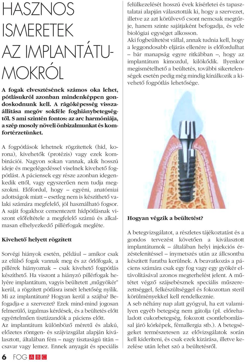 Nagyon sokan vannak, akik hosszú ideje és megelégedéssel viselnek kivehetô fogpótlást. A páciensek egy része azonban idegenkedik ettôl, vagy egyszerûen nem tudja megszokni.