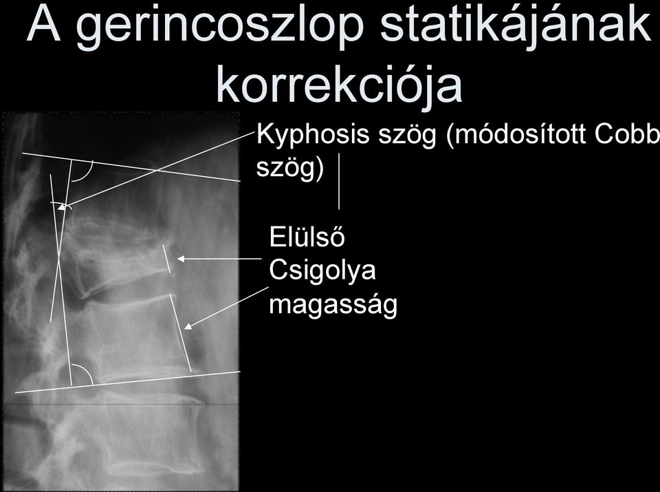 Kyphosis szög (módosított