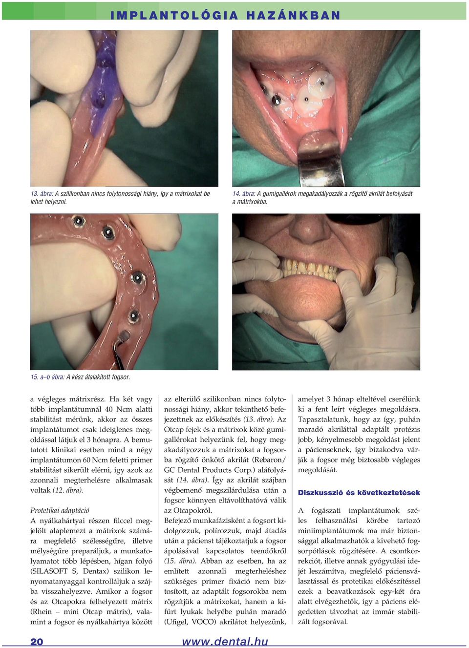 Ha két vagy több implantátumnál 40 Ncm alatti stabilitást mérünk, akkor az összes implantátumot csak ideiglenes megoldással látjuk el 3 hónapra.