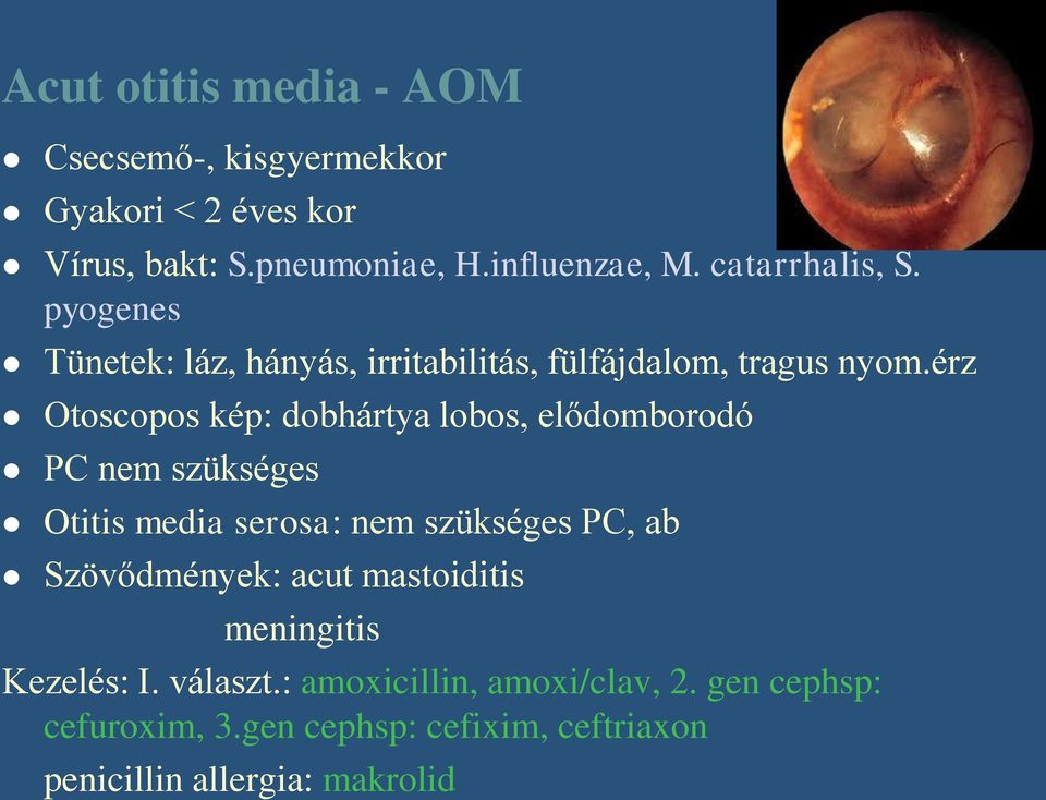 érz Otoscopos kép: dobhártya lobos, elődomborodó PC nem szükséges Otitis media serosa: nem szükséges PC, ab Szövődmények: