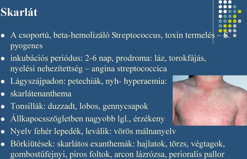 Lágyszájpadon: petechiák, nyh- hyperaemia: skarlátenanthema Tonsillák: duzzadt, lobos, gennycsapok Állkapocsszögletben