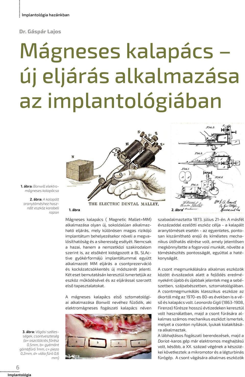 ábra: Vágási szélességek, csontveszteség (a= oszcillációs fűrész 0,5mm, b= gyémánt gömbfúró 1mm, c= piezo 0,2mm, d= vídia fúró 0,6 mm) Mágneses kalapács ( Magnetic Mallet=MM) alkalmazása olyan új,