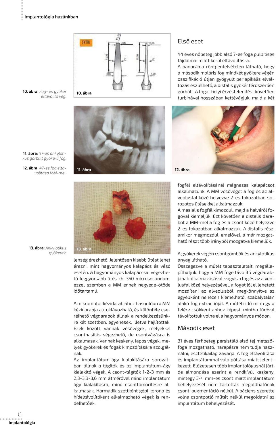 A fogat helyi érzéstelenítést követően turbinával hosszában kettévágjuk, majd a két 11. ábra: 47-es ankylotikus görbült gyökerű fog. 12. ábra: 47-es fog eltávolítása MM-mel. 11. ábra 12. ábra 8 13.