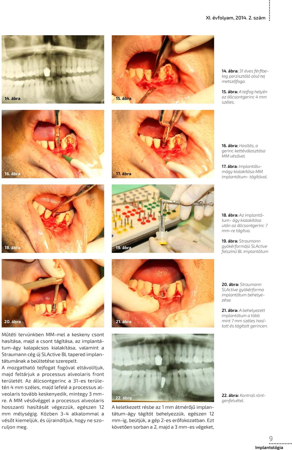 ábra: Az implantátum- ágy kialakítása után az állcsontgerinc 7 mm-re tágítva. 19. ábra: Straumann gyökérformájú SLActive felszínű BL implantátum 20. ábra 21. ábra 20.