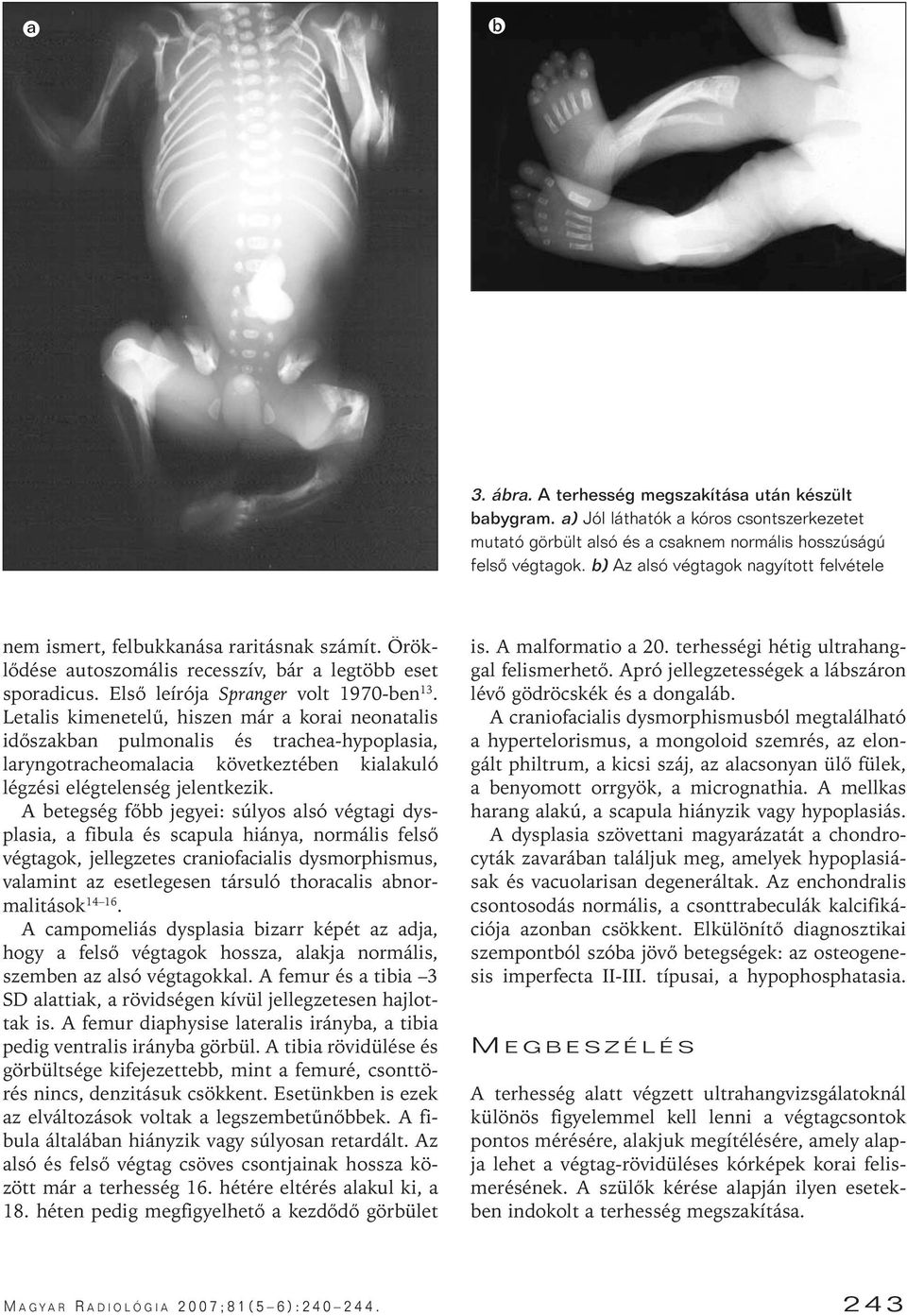 Letalis kimenetelû, hiszen már a korai neonatalis idôszakban pulmonalis és trachea-hypoplasia, laryngotracheomalacia következtében kialakuló légzési elégtelenség jelentkezik.