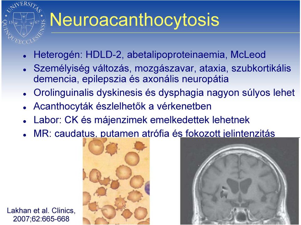 dyskinesis és dysphagia nagyon súlyos lehet Acanthocyták észlelhetők a vérkenetben Labor: CK és