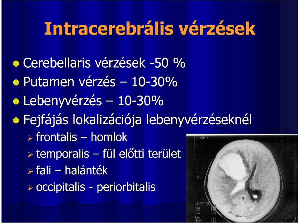 lokalizáci ciója lebenyvérz rzéseknél frontalis homlok