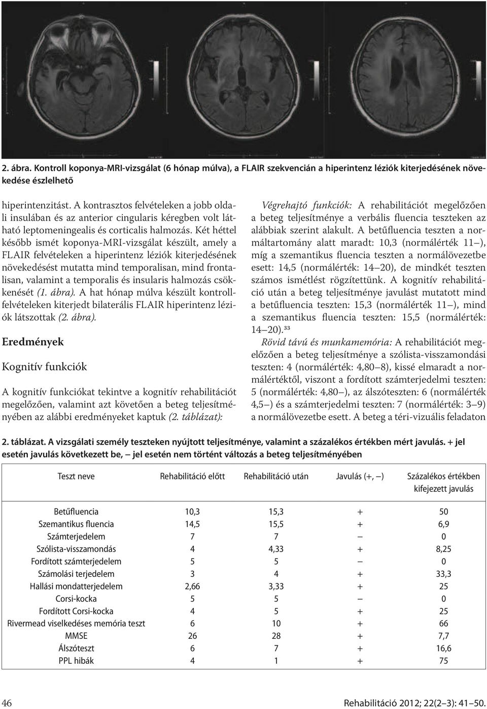 Két héttel később ismét koponya-mri-vizsgálat készült, amely a FLAIR felvételeken a hiperintenz léziók kiterjedésének növekedésést mutatta mind temporalisan, mind frontalisan, valamint a temporalis