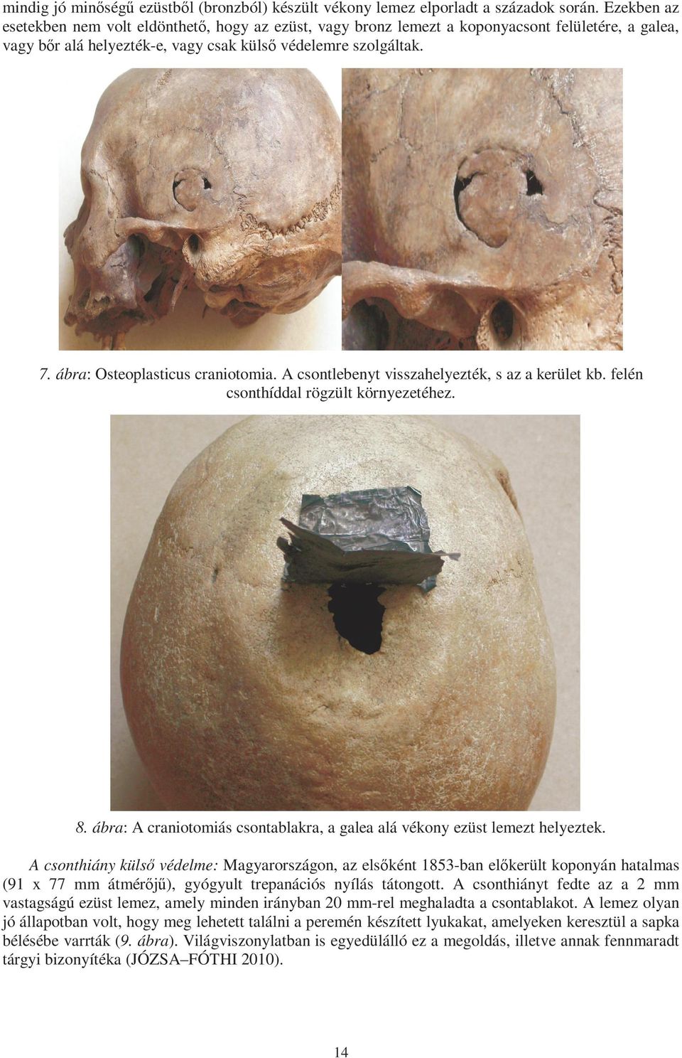 ábra: Osteoplasticus craniotomia. A csontlebenyt visszahelyezték, s az a kerület kb. felén csonthíddal rögzült környezetéhez. 8.