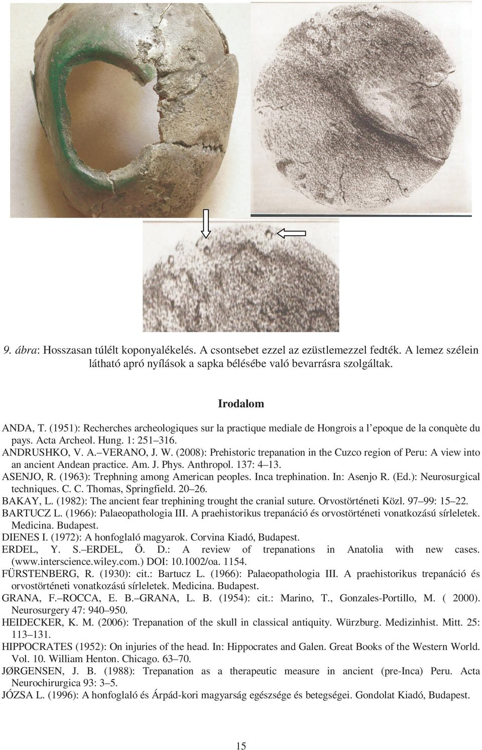 (2008): Prehistoric trepanation in the Cuzco region of Peru: A view into an ancient Andean practice. Am. J. Phys. Anthropol. 137: 4 13. ASENJO, R. (63): Trephning among American peoples.