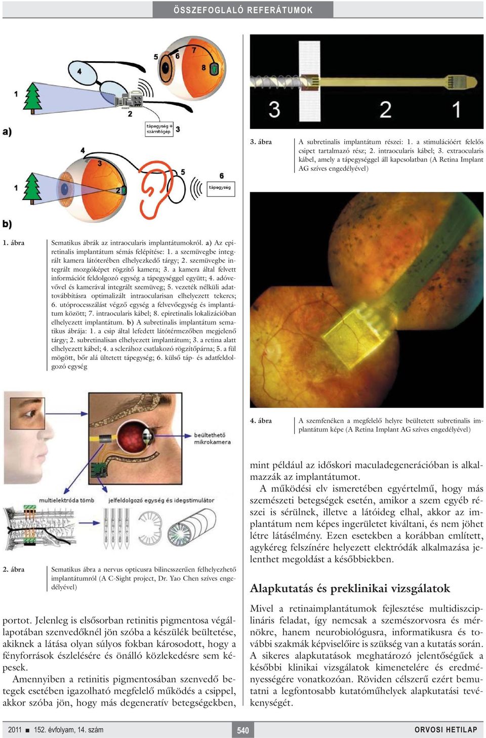 a) Az epiretinalis implantátum sémás felépítése: 1. a szemüvegbe integrált kamera látóterében elhelyezkedő tárgy; 2. szemüvegbe integrált mozgóképet rögzítő kamera; 3.