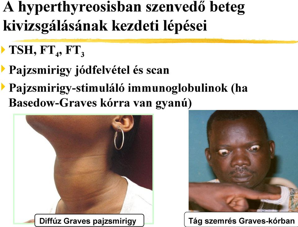 Pajzsmirigy-stimuláló immunoglobulinok (ha Basedow-Graves