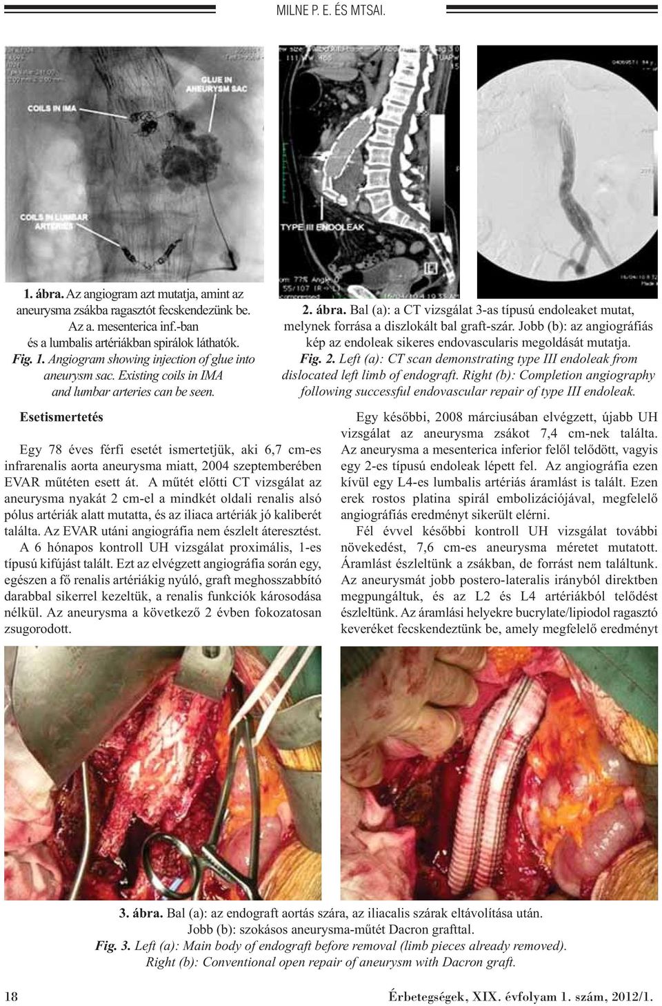 A műtét előtti CT vizsgálat az aneurysma nyakát 2 cm-el a mindkét oldali renalis alsó pólus artériák alatt mutatta, és az iliaca artériák jó kaliberét találta.