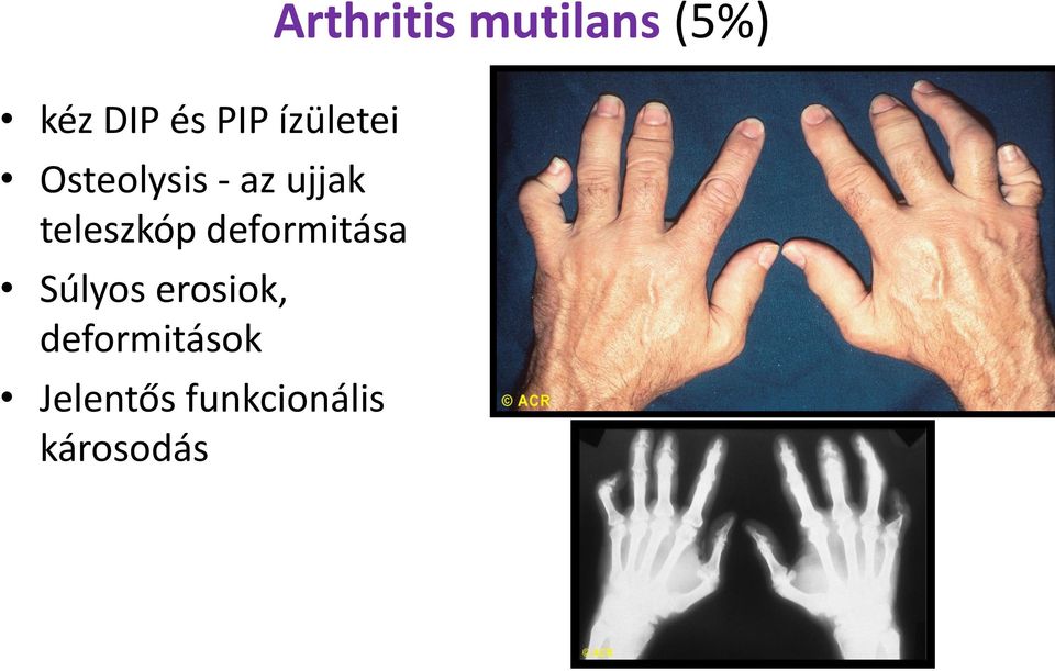 erosiok, deformitások Jelentős