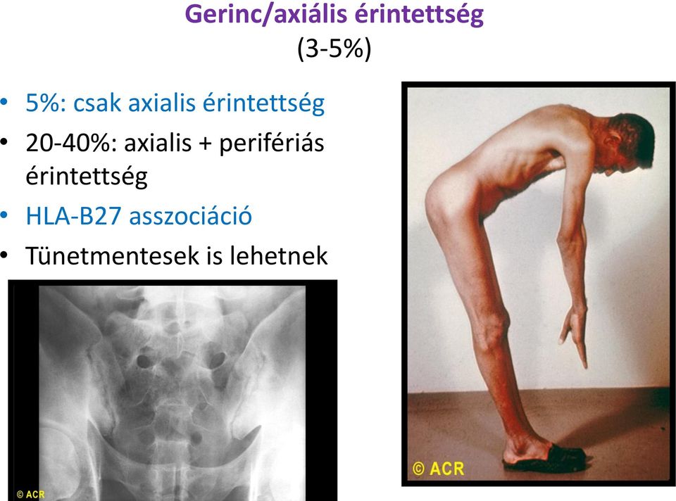 HLA-B27 asszociáció Tünetmentesek is