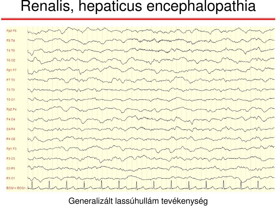 encephalopathia