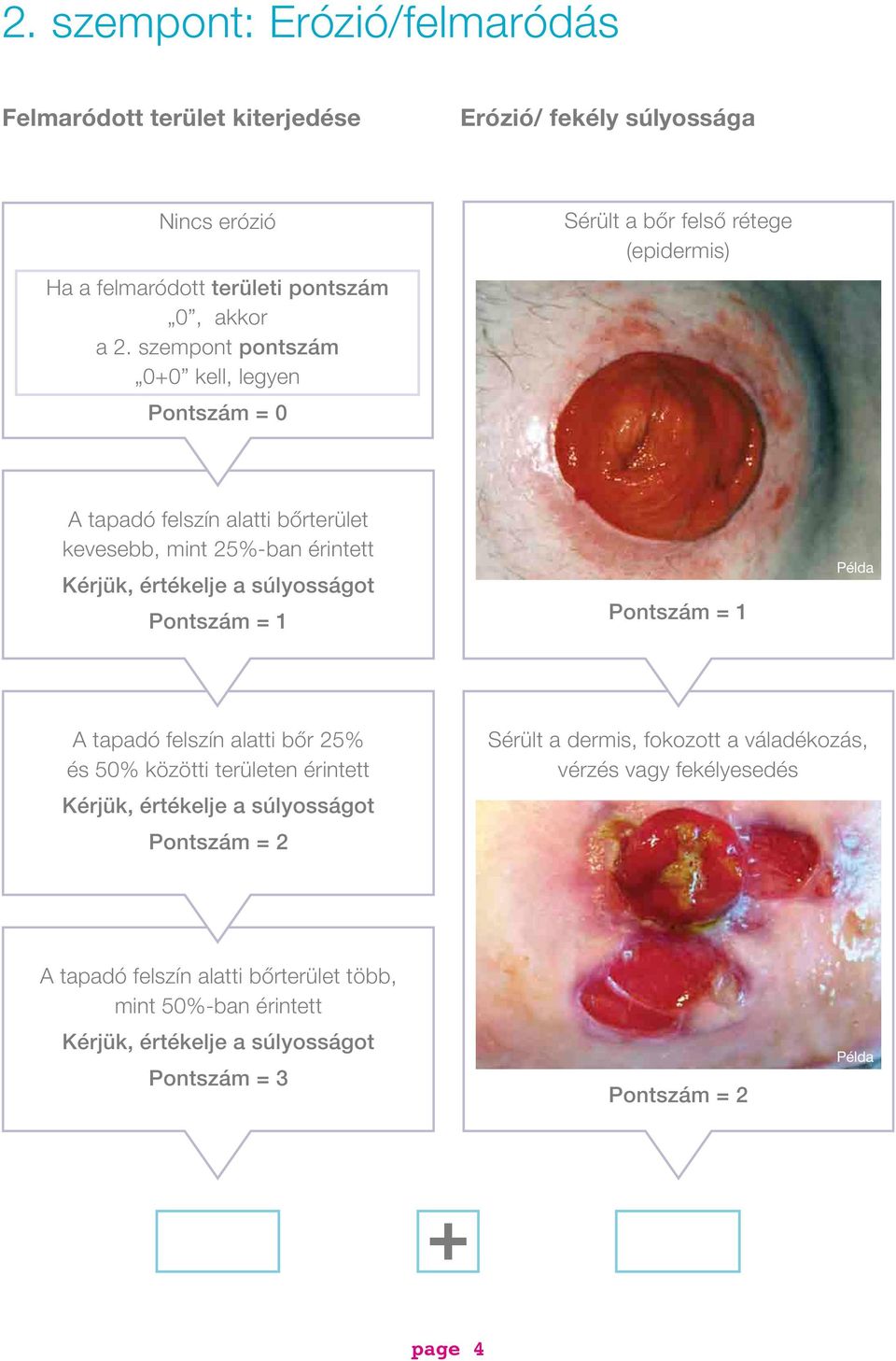25%-ban érintett Pontszám = 1 Pontszám = 1 Példa A tapadó felszín alatti bőr 25% és 50% közötti területen érintett Pontszám = 2 Sérült a dermis,