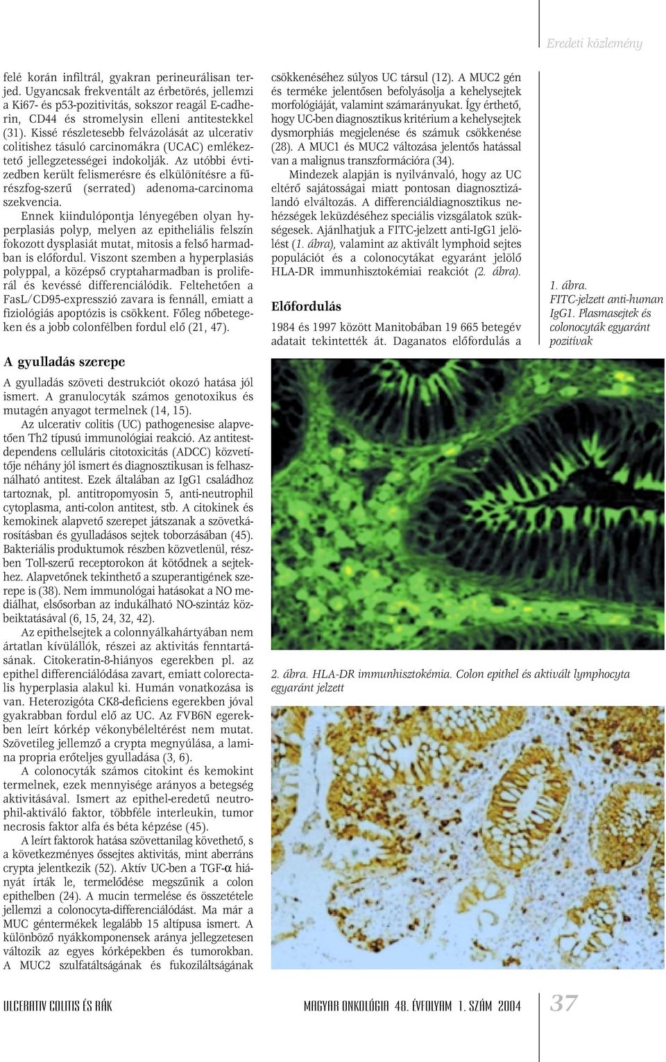 Az utóbbi évtizedben került felismerésre és elkülönítésre a fûrészfog-szerû (serrated) adenoma-carcinoma szekvencia.