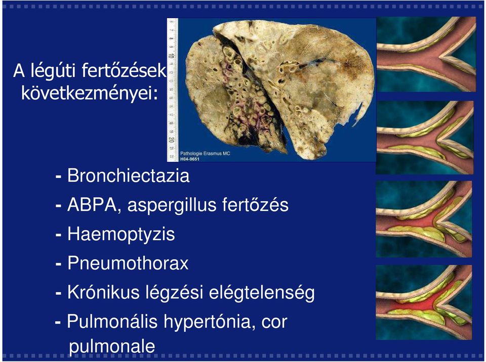 Haemoptyzis - Pneumothorax - Krónikus légzési