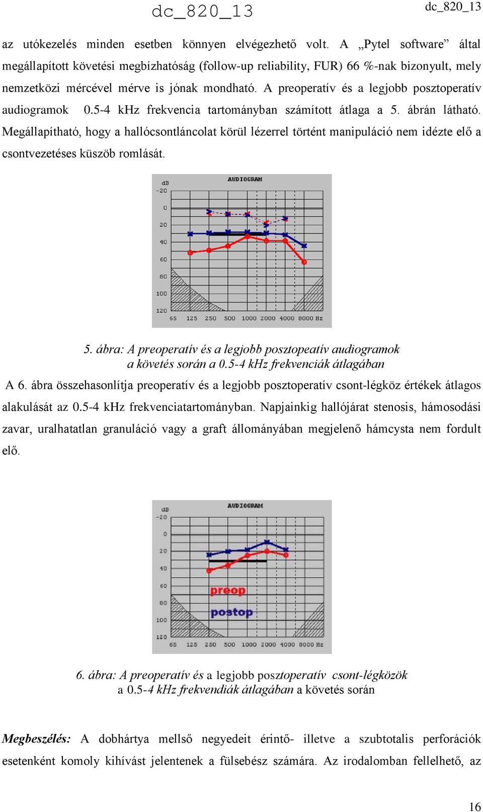 A preoperatív és a legjobb posztoperatív audiogramok 0.5-4 khz frekvencia tartományban számított átlaga a 5. ábrán látható.