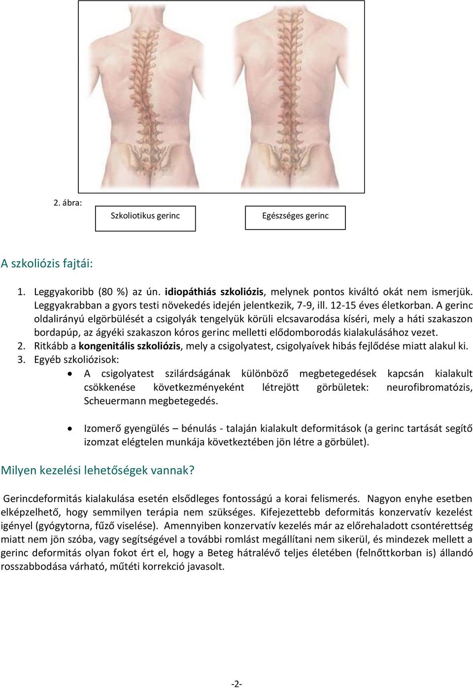 A gerinc oldalirányú elgörbülését a csigolyák tengelyük körüli elcsavarodása kíséri, mely a háti szakaszon bordapúp, az ágyéki szakaszon kóros gerinc melletti elődomborodás kialakulásához vezet. 2.