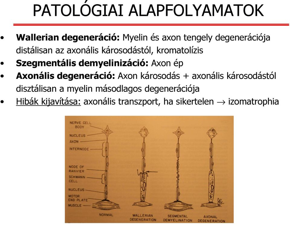 ép Axonálisdegeneráció: Axon károsodás + axonális károsodástól disztálisan a myelin