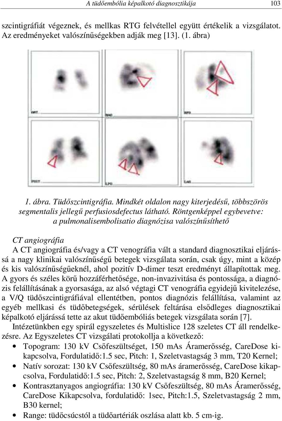 Röntgenképpel egybevetve: a pulmonalisembolisatio diagnózisa valószínűsíthető CT angiográfia A CT angiográfia és/vagy a CT venográfia vált a standard diagnosztikai eljárássá a nagy klinikai