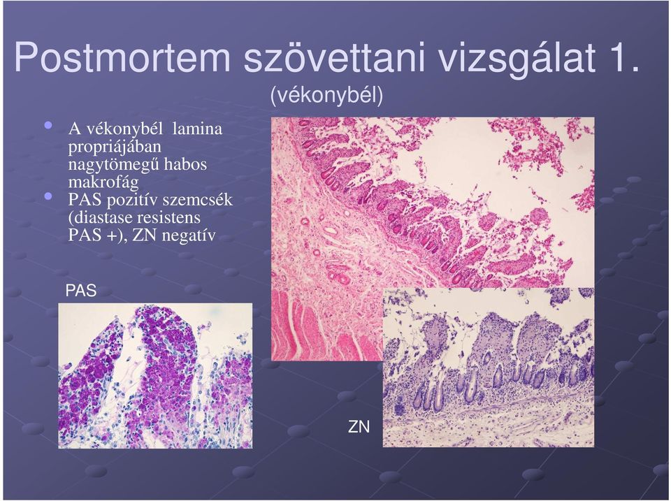 propriájában nagytömegű habos makrofág PAS