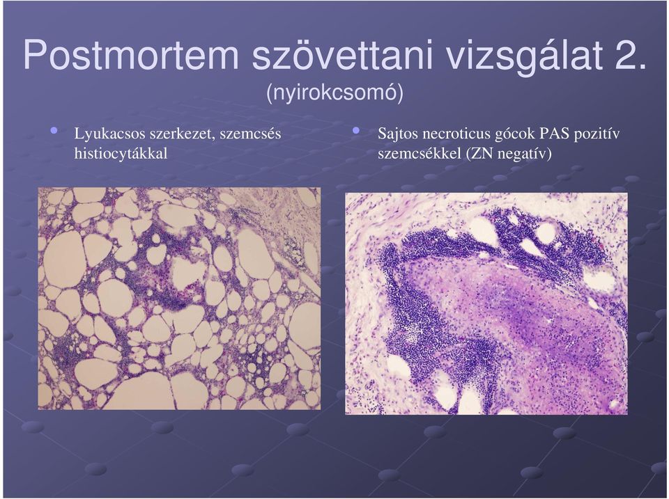 szemcsés histiocytákkal Sajtos