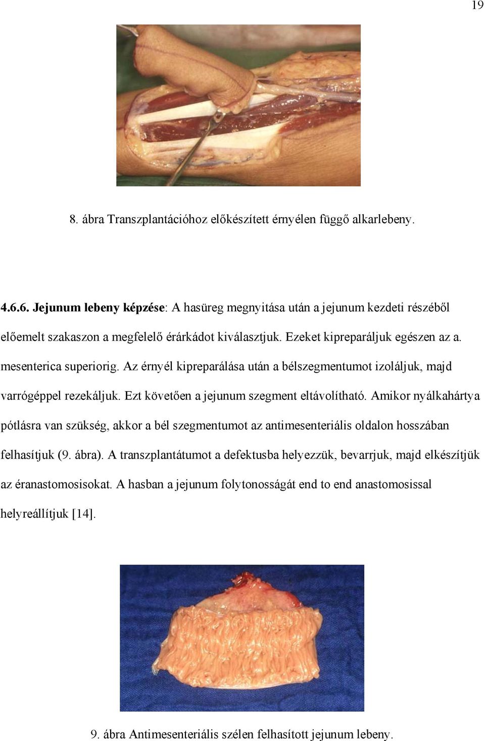 Az érnyél kipreparálása után a bélszegmentumot izoláljuk, majd varrógéppel rezekáljuk. Ezt követ en a jejunum szegment eltávolítható.