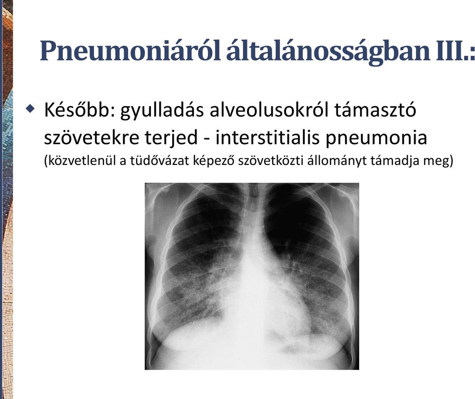 szövetekre terjed - interstitialis pneumonia