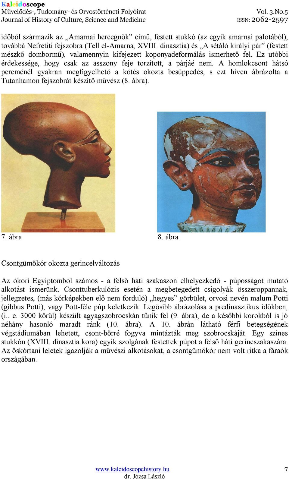 A homlokcsont hátsó pereménél gyakran megfigyelhető a kötés okozta besüppedés, s ezt híven ábrázolta a Tutanhamon fejszobrát készítő művész (8. ábra). 7. ábra 8.