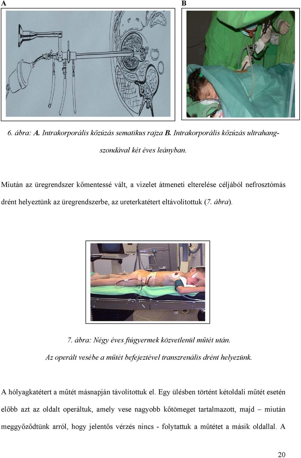 7. ábra: Négy éves fiúgyermek közvetlenül m tét után. Az operált vesébe a m tét befejeztével transzrenális drént helyezünk.